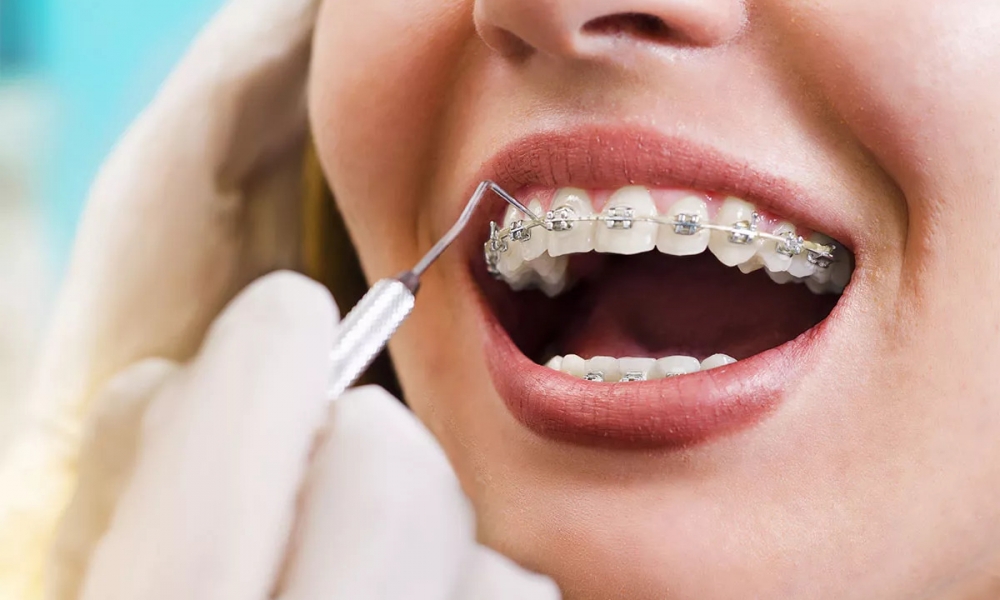 Orthodontics / Braces Treatment
